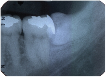 Figure 2 Radiograph of a 41-year-old man with acute pericoronitis with pericoronal radiolucency below the crown.