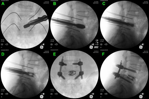 Figure 3 (A and B) The trial cage position was adjusted and confirmed by intraoperative fluoroscopy. (C and D) The cage was expanded by the special access cannula. (E and F) The expanded cage and pedicle screws position was confirmed by intraoperative fluoroscopy.