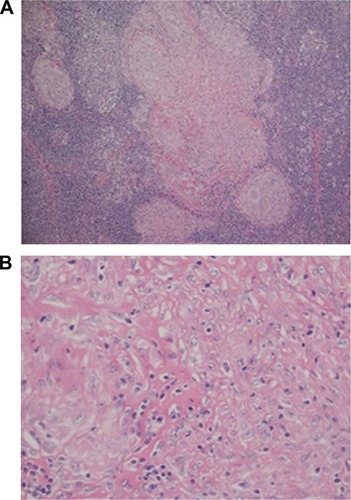 Figure 2 Postoperative pathology of spleen.Notes: A: magnification ×10; B: magnification ×40.