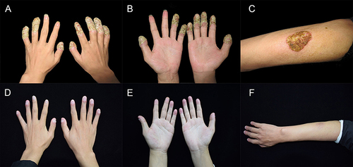 Figure 1 Clinical appearance before and 28 weeks after the treatment with Ustekinumab. (A–C) Clinical appearance of the dorsum of the hand, nails, flexion side of fingers and the right forearm before the treatment with Ustekinumab. (D–F) Clinical appearance of the dorsum of the hand, nails, flexion side of fingers and the right forearm 28 weeks after the treatment with Ustekinumab.