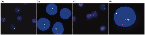 Figure 2. FISH findings on flow-sorted cells. (a) Loss of TP53 in 85% cells in CLL/SLL component. (b) No loss of TP53 in HGBCL component. (c) No MYC rearrangement in CLL/SLL component. (d) MYC rearrangement in 98% of cells in HGBCL component. (a–b) TP53 (17p13) probe (Red) and CEP17 (chr. 17 centromere) probe (Green). (c–d) MYC (8q24) break-apart probes.