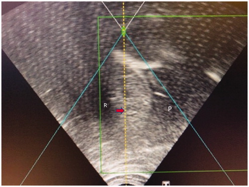 Figure 4. HIFU sonographic image of a small HCC in segment 8 (red arrow) being treated, after the instillation of 800 ml of normal saline into the right pleural cavity as artificial right pleural effusion (area denoted by ‘P’). A rib (denoted by ‘R’) is partially obscuring the liver in this intercostal view, therefore breath-holding is mandatory during sonication.