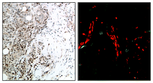 Figure 2. Immunohistochemical (A) and immunofluorescent (B) images showing localization of activated STAT3 (red) on the edge of human breast tumors in association with myeloid (CD33+, green) cells.