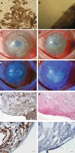 FIGURE 1  (a) Impression cytology of cornea showing positive staining for cytokeratin 19, indicating a conjunctival cell phenotype. (b) Confocal microscopy of epithelial cell outgrowth from the biopsy (lower right) at day 12 in culture. (c) Preoperative photograph showing 360° limbal stem cell deficiency and conjunctivalization of the cornea. (d) Fifteen days post stem cell transplant, there is limbal injection with corneal edema and superficial vascularization of the graft. Eighteen days postoperatively epithelial defects become visible (e), which coalesce to form one large defect by 1 month postoperatively (f). (g) Immunohistochemistry of removed corneal pannus with anti-D2-40 a lymphocyte endothelial marker showing staining around numerous lumen-like structures within the corneal stroma, 200× magnification. (h) Serial section of removed corneal pannus with hematoxylin and eosin stain showing infiltration of numerous neutrophils into the graft, 200× magnification. (i) Arrowheads indicate lymph vessel lumen with lymphatic endothelium staining positive for anti-D2-40 antibody, 400× magnification. (j) Arrowheads indicate lymph vessel lumen with negative staining with anti-CD31, 400× magnification. Scale bars in (g) and (h) represent 100 and 50 µm in (i) and (j).