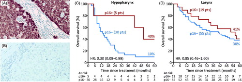 Figure 1. p16-positive hypopharynx cancer showing strong specific tumour cell expression of p16 (A) and a p16-negative hypopharynx cancer (B). Actuarial estimated overall survival rates in patients with p16-positve and p16-negative cancer of the hypopharynx (C) and larynx (D).