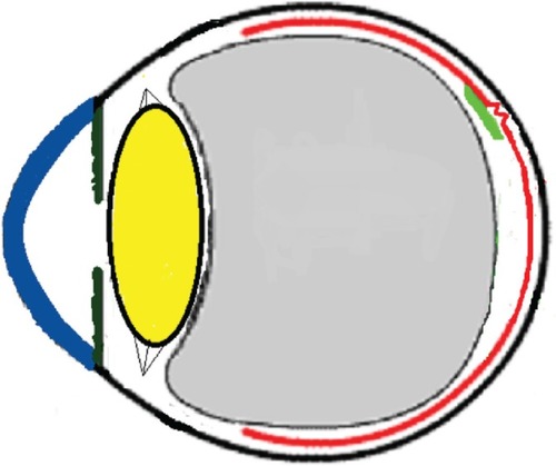 Figure 13 Schematic drawing showing further contraction of one edge resulting in epiretinal membrane release of tension on the fovea.