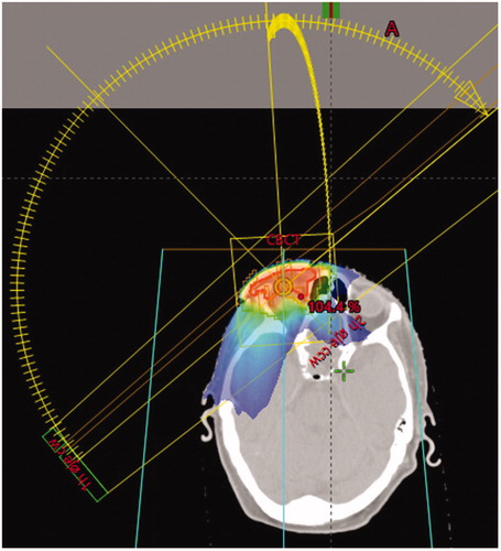 Figure 2. Treatment plan. Target contour shown as a red line. The target included the whole upper eyelid, the adjacent extraocular soft tissues of the anterior part of the orbit, and the soft tissues of the face surrounding the eye. Radiation doses shown in color wash. One coplanar and one non-coplanar partial arc were used. The total prescribed dose was 50 Gy in 25 fractions with 5 fractions/week. 6 mm bolus was added over the entire eye.