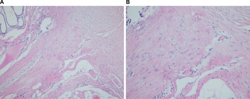 Figure 2 Extra-abdominal desmoid tumor demonstrating infiltrative border (A) with characteristic features of spindle cells among dense collagenous and fibrous stroma (B).