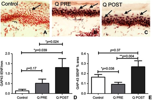 Figure 5 Immunohistochemistry in skin biopsies for GAP43, before and after capsaicin 8% patch treatment. Representative image of intra-epidermal nerve fibers (arrowed) and sub-epidermal nerve fibers from (A) control subjects, at the baseline visit (B, Q PRE) and, after capsaicin 8% patch treatment (C, Q POST), magnification x40. (D) Bar chart of intra-epidermal nerve fibers for GAP43 (IENF) counts; (E) bar charts of sub-epidermal (SENF) analysis (% area) for GAP43.