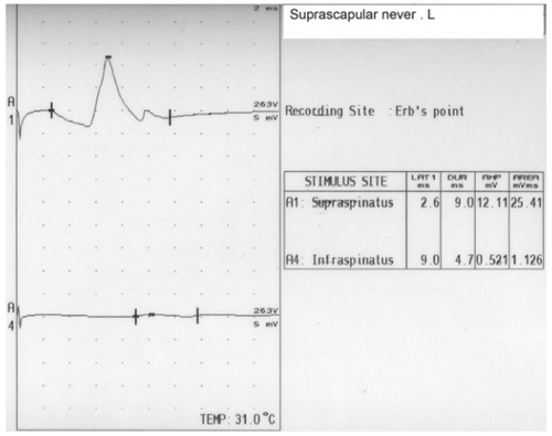 Figure 4 A nerve conduction study of the left suprascapular nerve reveals no response in the infraspinatus division.