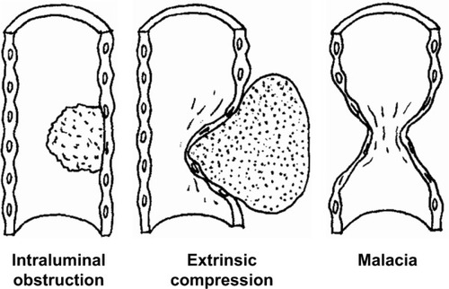 Figure 1 Classification of the stenosing airway disease by the type of airway involvement.