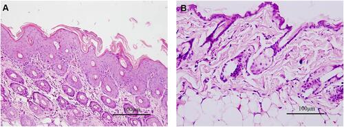 Figure 4 Histopathological examination of skin tissue of (A) Model group and (B) Control group on day 8. Hematoxylin and eosin, scale bar=100μm.