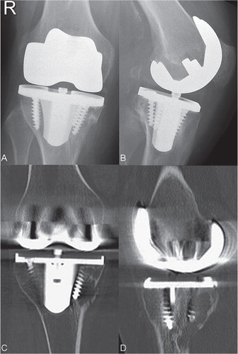 Figure 1. Anterioposterior and lateral radiograph and CT scans showing osteolysis of the distal right femur and the proximal tibia 12 years after implantation of a cemenless TKA.