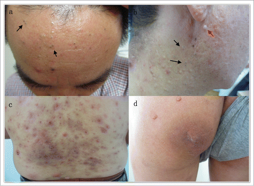 Figure 1. A patient with scarring folliculitis type of acne inversa who was smokers and worked in a packing plant. (a) Double comodones on the forehead (black arrows). (b) Double comodones (black arrows) on the neck and an epidermal cyst (red arrow) on the mandibular. (c) Follicular papules(folliculitis) on the back. (d) Hypertrophic scar on the buttock.