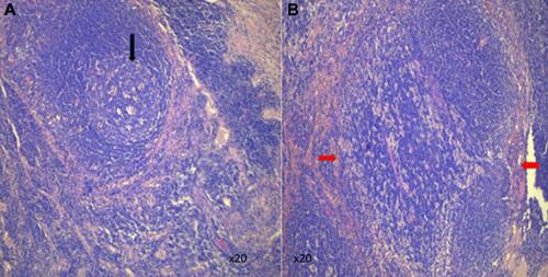 Figure 2 Lymph node tissue showing increased follicles (black arrow, (A)) and numerous histiocytosis (red arrows, (B)).