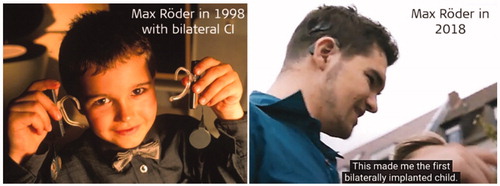 Figure 33. Max Röder, the first bilaterally implanted CI child in the year 1998, who is now a computer science graduate, living his life like every other normal-hearing person (Image courtesy of MED-EL).
