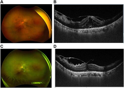 Figure 3 (A) Fundus photo of an eye with intermediate uveitis showing marked vitreous haze and membranes. (B) Marked macular edema and subretinal fluid on OCT. (C) Three days after DEX implant showing marked improvement in vitreous haze and membranes. (D) Resolution of macular edema.