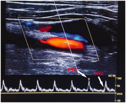 Figure 1. A schematic presentation of common carotid artery Doppler findings. PSV: peak systolic velocity; EDV: end-diastolic velocity.