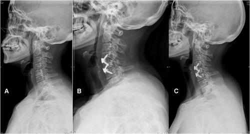 Figure 4 Typical case in the Zero-P VA group. The patient was diagnosed with cervical spondylotic radiculopathy. (A–C) Anterolateral view of the cervical spine preoperatively, postoperatively, and at the last follow-up. The preoperative SVA was large, and the postoperative SVA was significantly reduced. There was no significant change in other normal cervical spine parameters after the operation, and the cervical sagittal curvature was maintained over the long term.