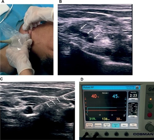 Figure 2 PRF procedure of brachial plexus under ultrasound guidance (A–D).