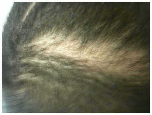Figure 2 Regrowth noted by provider and patient’s mother after 6 weeks of griseofulvin.