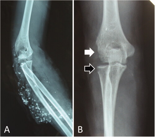Figure 4. Radiographs of the patient in Case 2. (A) Radiograph taken immediately after the injury. The arm and elbow were contaminated with several windshield pieces. (B) Radiograph taken after debridement. The white arrow indicates deficient humeral condyles, while the black arrow indicates radial head defects.