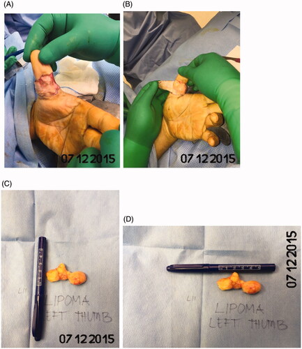 Figure 3. (A–D) A rectangular radially incision was made over the left thumb and the mass was excised completely.