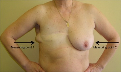 Figure 6 Ultrasound measuring points after mastectomy (measurements II, III, and IV).