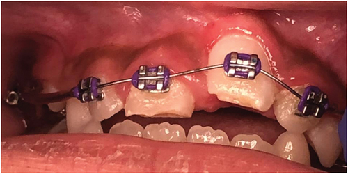 Figure 8. Orthodontic progress photo at four months since initial injury.