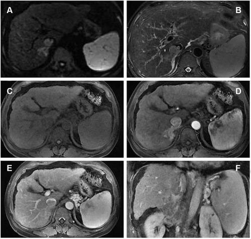 Figure 3 Dynamic contrast‐enhanced magnetic resonance imaging (DCE‐MRI) displayed enhancement in the arterial phase and a defect in the venous phase ((A) DWI, (B) T2WI, (C) T1WI, (D) arterial phase, (E) portal phase, (F) coronal portal phase T1WI).