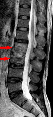 Figure 5 MRI showed tuberculosis of L2 and L3 vertebrae (arrows).