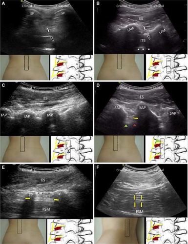 Figure 7 The sagittal planes for the spinous processes (A), laminae (B), inferior articular processes (C), superior articular processes (D), and transverse processes (E) of the lumbar spine; the oblique sagittal plane for the lumbar plexus (F).