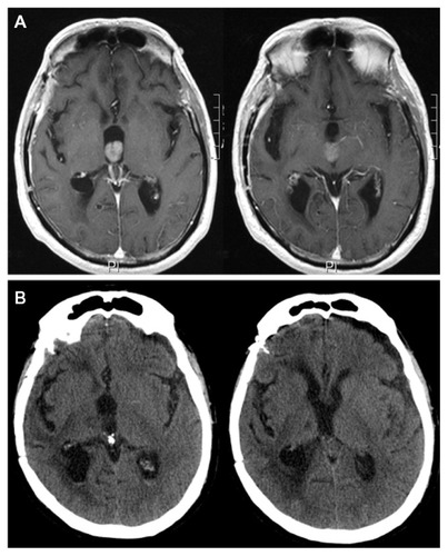 Figure 2 The patient’s third ventricle nodular lesion.