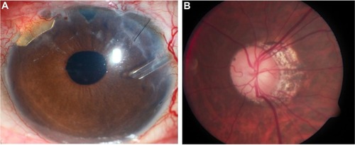 Figure 2 Four months following surgery, left eye anterior segment shows gold shunt in the superonasal quadrant in good position (A), with advanced cupping in a highly myopic left optic nerve (B).