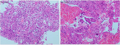 Figure 2 Pathology results showed fungal infection with mild dysplasia of histiocytic cells.