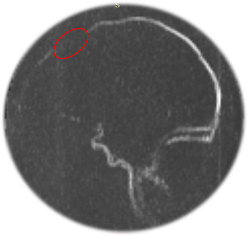 Figure 1 MRV of brain showing superior sagittal sinus thrombosis at anterior aspect. The red circled area is indicating the location of the thrombus.