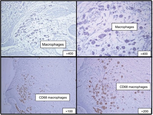 Figure 3 Positive reaction with the monoclonal anti-CD68 antibody in femoral bone tissue of a patient living with HIV.