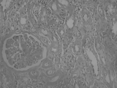 Figure 4. H + E (× 200). Increase of eosinophilic mesangial matrix on glomerular tuft, formation of mesangial nodule, and thickness of tubular basal membrane.