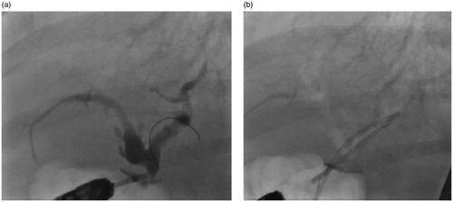 Figure 7. The fluoroscopy views of patient (number 4) with hepaticojejunostomy anastomotic stricture (a) before and (b) after stenting with Archimedes stents.