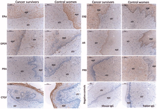 Figure 1. Representative images of immunostaining in the vaginal wall of cervical cancer survivors and controls. ERα: estrogen receptor α; ERβ: estrogen receptor β; GPER: G-protein coupled estrogen receptor 1; AR: androgen receptor; PRA: progesterone receptor A; PRB: progesterone receptor B; CTGF: connective tissue growth factor; epi: epithelium; str: stroma. Negative controls, where the primary antibody is replaced with the specie relevant IgG, are shown in the right bottom panel. The bar represents 100 µm.