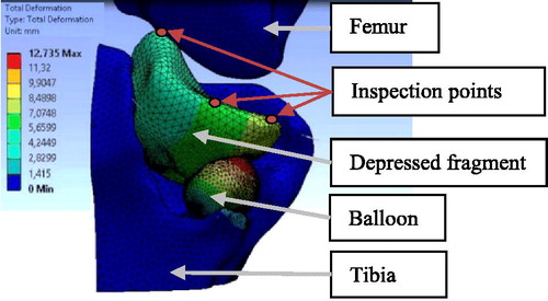 Figure 3. Simulation results on the external tibial plateau geometries: displacement field at 1.93cm3  injection. (The separate fragment is masked).