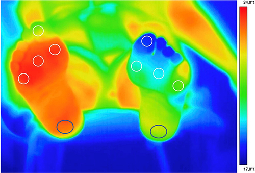Figure 6 Example of a thermography image of the foot. Plantar thermal image of an individual with right forefoot deformity and tight tendo-achilles with significant forefoot pressure and pre-ulcerative callus formation over the 1st and 3rd metatarsophalangeal joints. Note the significant increase in temperature which may potentially signal impending ulcer development. The circles indicate various present region of interest allowing easier identification of the most relevant areas. Caution needs to be taken while interpreting the results, especially as both hot and cooler than expected areas can also be triggered by environmental factors such as ambient temperature, the type of footwear worn etc. The cooler blue toes on the left foot in the image were related to temperature, but in the right individual may also indicate peripheral arterial disease.