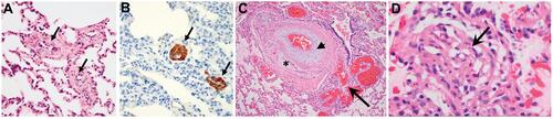 Figure 1 Typical histopathological characteristics of PAH.Notes: (A, B) Lung tissue from a HPAH patient with a mutation in the CAV1 gene (grades I and II). Hematoxylin and eosin staining may show pulmonary vascular smooth muscle cell proliferation, medial thickening of small pulmonary arteries (A, arrows), as confirmed by immunohistochemical staining of α‐smooth muscle actin (B, arrows).Citation117 (C, D) Lung biopsy from a HPAH patient with a mutation in the KCNK3 gene. (C) Fibrosis (arrowhead), intimal proliferation, and recanalization (asterisk), with an adjacent angiomatoid lesion (arrow) typical of HPAH/IPAH (grade III). (D) Grade IV PAH disease may include plexiform lesions characterized by intimal and endothelial proliferation (arrow).Citation118 Copyright ©2017. John Wiley and Sons. Reproduced from Ma L, Chung WK. The role of genetics in pulmonary arterial hypertension. J Pathol. 2017;241(2):273–280.Citation4