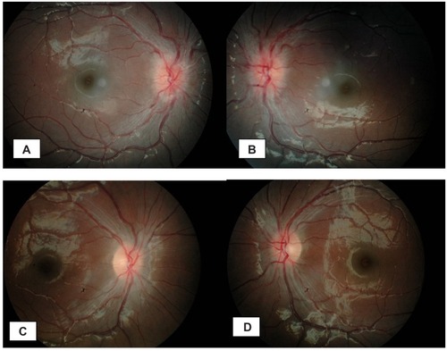 Figure 1 (A and B) fundus photographs show bilateral swollen disc on presentation. (C and D) resolved bilateral disc swelling at one month after treatment.