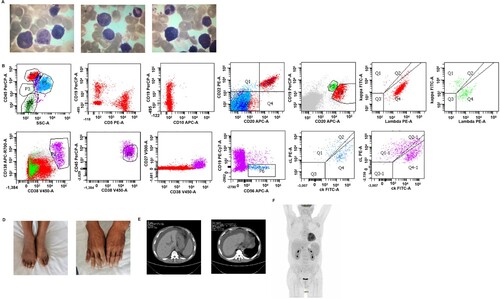 Figure 1. Clinical manifestation and laboratory examinations of patients at diagnosis. (A) The morphological analysis of the patient’s bone marrow. The cell body is larger than normal, the cytoplasm is rich and blue, the nuclear chromatin is rough and irregular, and the nucleolus is not clear. (B + C) Flow cytometry showed 3% monoclonal B cells in bone marrow, expressing CD19+/CD20++/CD10−/CD38−/ CD5−/CD138−. (D) Pigment deposition in the dorsum of hands and ankles. (E) Computed tomography scans showed massive ascites. (F) 18F-FDG PET/CT was performed and showed multiple lymphadenopathy in the cervix and axilla with no hypermetabolic lesions.