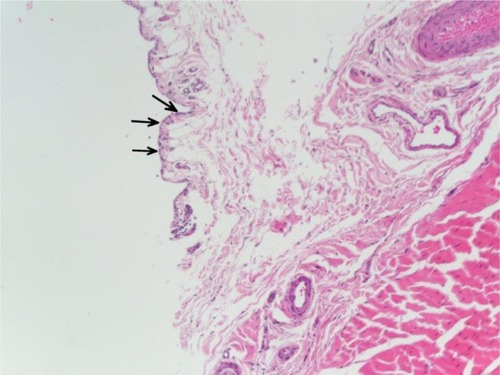 Figure 6 This histologic image of the long head of the biceps tenosynovium demonstrates reactive features, including synovial proliferation, enlargement of surface synovial cells (arrows), and vascular proliferation.