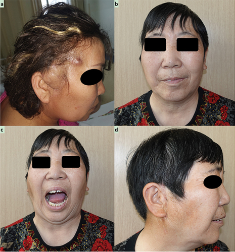 Figure 1. Preoperative extraoral view reveals a prominent bulge coated with normal skin color and temperature. Postoperative photographs reveals a basically symmetrical facial profile (b) frontal view; d. right side view), and (c) normal mouth opening of 45 mm.