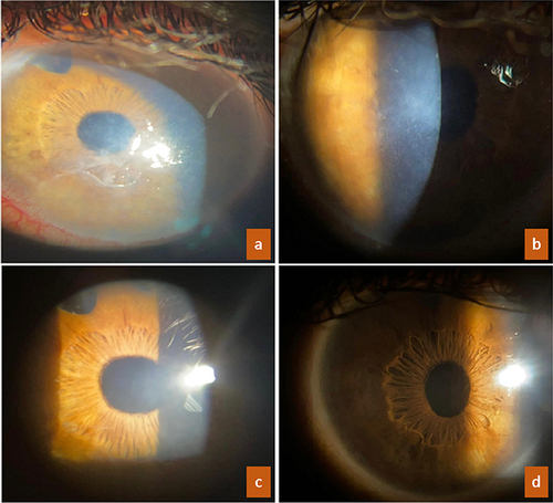 Figure 1 ((a), right eye; (b), left eye) Slit-beam photographies demonstrate stromal opacities with branching lines in both eyes, complicated by corneal erosions in right eye; ((c), right eye; (d), left eye) after 3 months from combined excimer laser treatment, corneal clarity has been recovered with the resolution of epithelial erosions and the disappearance of stromal opacities.