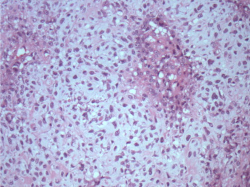 Fig. 2 H&E-stained section at 20× magnification shows malignant neoplastic cells within chondroid matrix material.