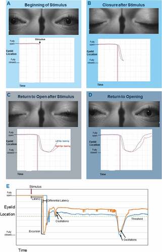 Figure 3. A-E: Diagrammatic representation of parameters paired with eye photographs of a stimulated blink. A-D: Sequential stages of the stimulated blink reflex with paired eyelid location over time charting. E: Complete charting of a stimulated blink reflex with parameters labeled. The “threshold” line is considered the horizontal mid-pupil position. Time under threshold (not shown) measures the total time the eyelid remains below the mid-pupillary line (i.e. threshold).